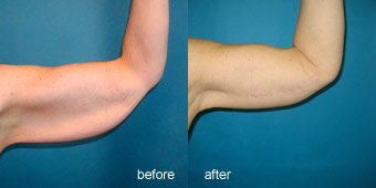 Surgeries - Arm Lift Before After