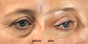 Surgeries - Eyelid Before After