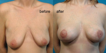 Surgeries - Breast Lift Before After