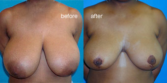 Surgeries - Reduction Before After