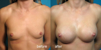 Surgeries - Augmentation Before After