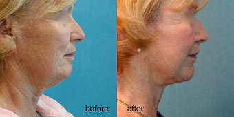 Surgeries - Facelift Before After