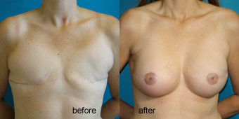 Surgeries - Reconstruction Before After