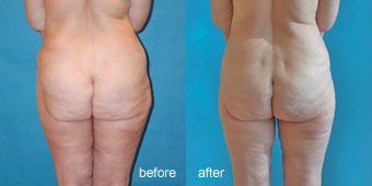 Surgeries - Liposuction Before After