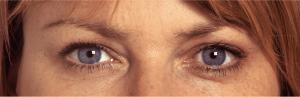 Crowfeet after botox treatment     