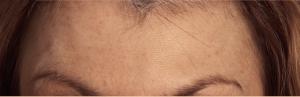 Forehead lines after botox treatment 
