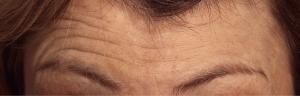 Forehead lines before botox treatment 