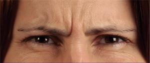 Frown lines before botox treatment