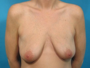 Breast Lift 1