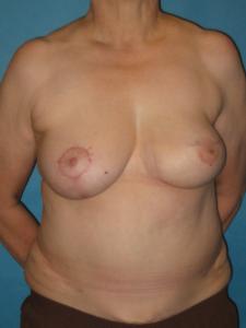 Patient after breast reconstruction using TRAM 
