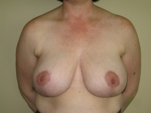 Patient after breast reduction procedure