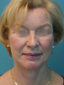 Patient after facelift procedure 
