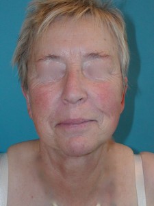 Patient after facelift procedure 