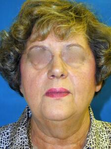 Patient before facelift procedure 