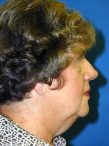 Patient before facelift procedure 