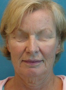 Patient before facelift procedure 