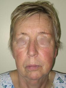 Patient before facelift procedure 