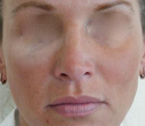 Fillers - Cheeks after treatment  
