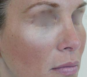 Fillers - Cheeks after treatment (side view)  
