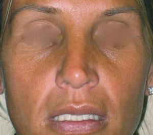 Fillers - Cheeks before treatment   