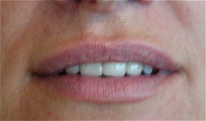 Fillers - Lips after treatment 