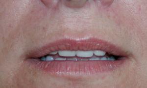 Filler Lips