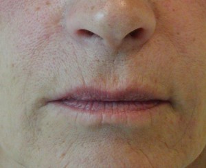 Fillers - Nasal labial fold after treatment  