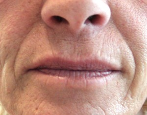 Fillers - Nasal labial fold before treatment  