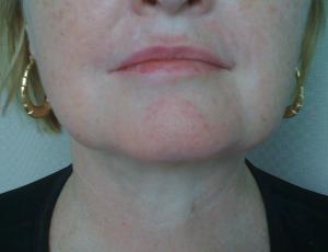 Patient after liposuction procedure    