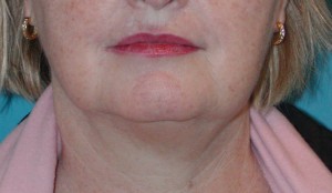 Patient before liposuction procedure    