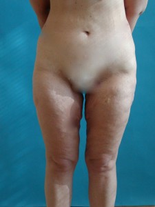 Patient after liposuction procedure