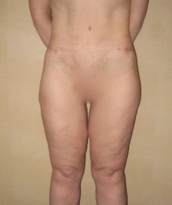 Patient after lower body lift procedure